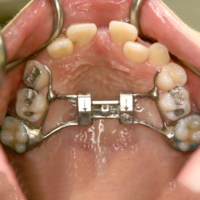 palatal expander